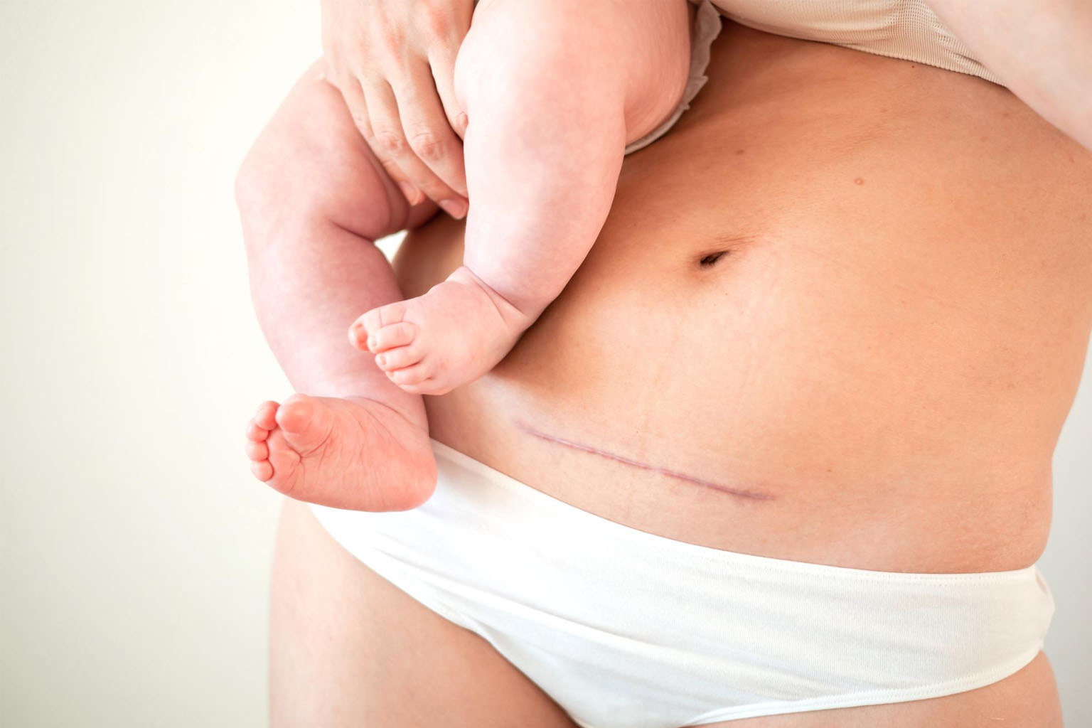 Cicatrice de césarienne sur le ventre d’une mère tenant son bébé dans les bras